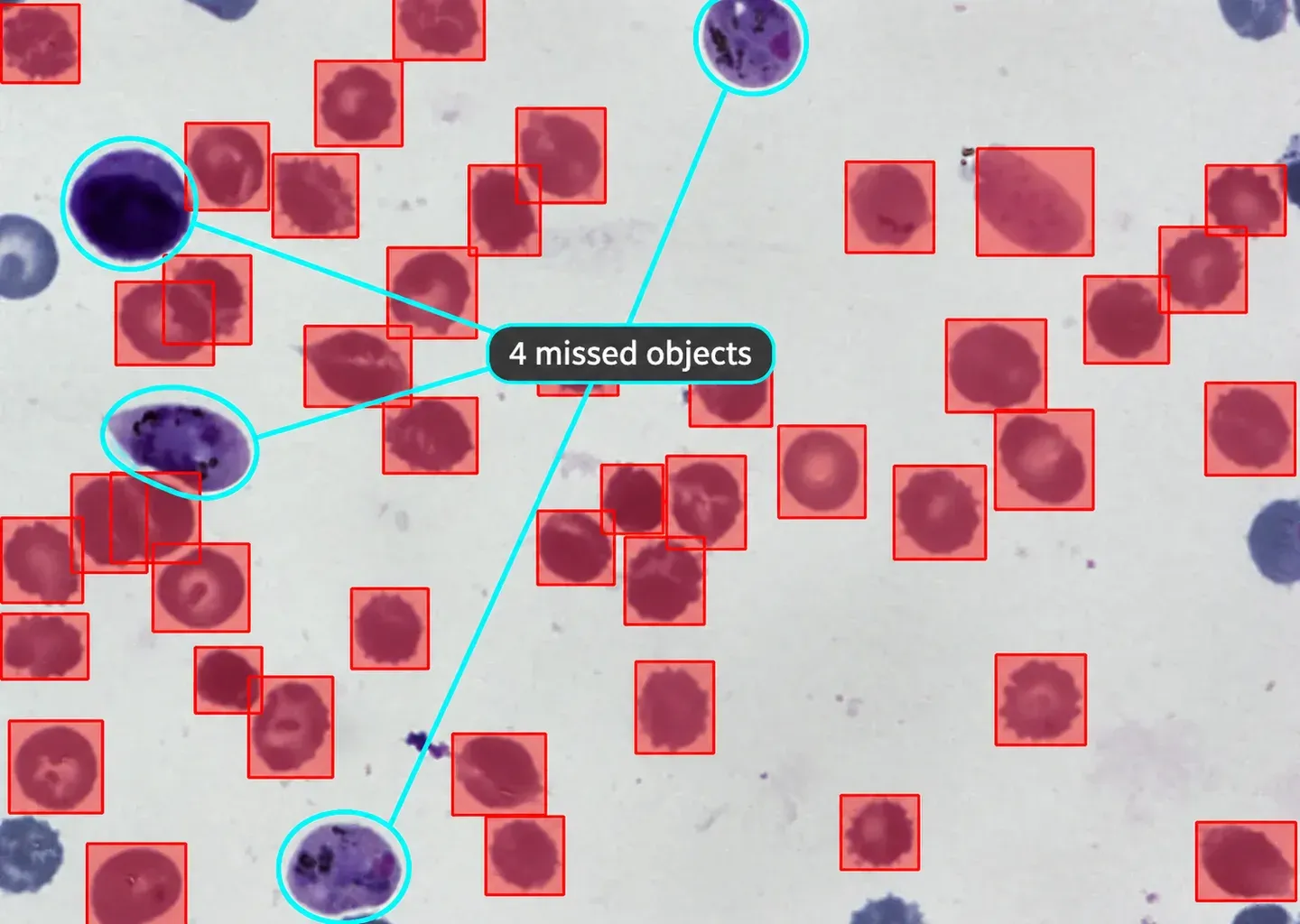 Malaria blood smear with cyan callouts around four objects missing from the submitted annotation
