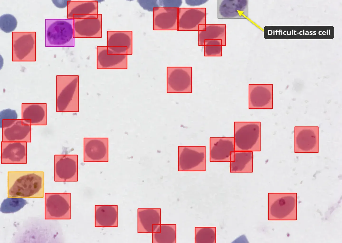 Malaria blood smear with a callout pointing to a difficult-class cell